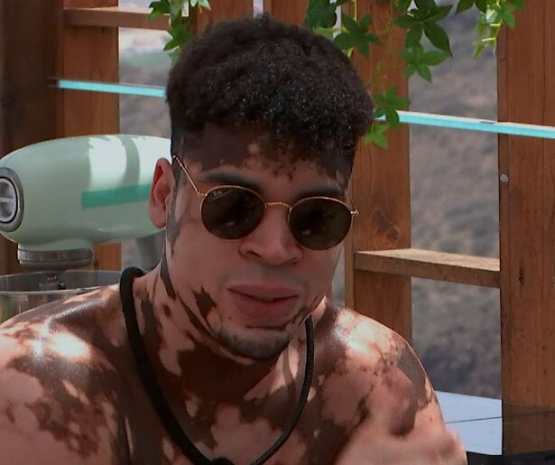 Love Island-deelnemer Gideon openhartig over zijn vitiligo